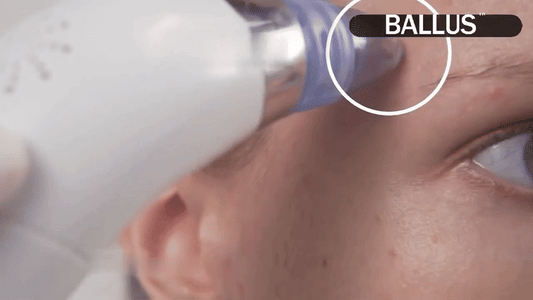 💆‍♀️ Pore Cleaning Device ✨ | Blackhead Remover Vacuum 🔋 USB Rechargeable 🌟